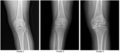 Impact of autologous platelet-rich plasma therapy vs. hyaluronic acid on synovial fluid biomarkers in knee osteoarthritis: a randomized controlled clinical trial